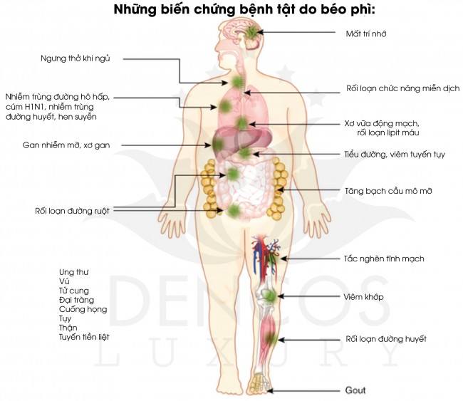 Tiêu tích giáng phì - Biến chứng nguy hiểm của bệnh Béo phì